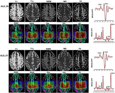 Imaging Neurochemistry and Brain Structure Tracks Clinical Decline and Mechanisms of ALS in Patients